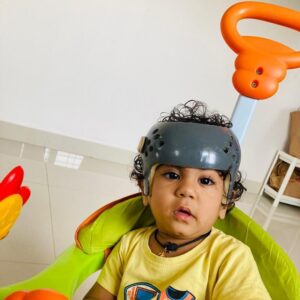 Rare Surgery for a Baby with Fused Skull